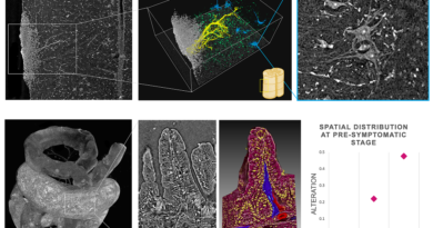 Alterazioni patologiche nel sistema nervoso centrale e nell'intestino