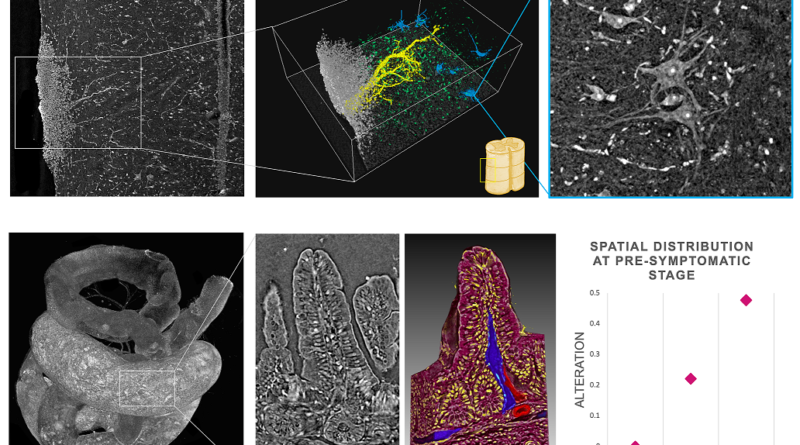 Alterazioni patologiche nel sistema nervoso centrale e nell'intestino